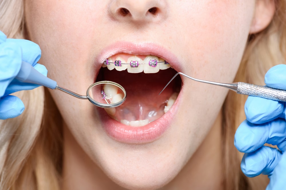 Am I A Candidate For Orthodontics? FAQ - girl braces examination mouth open